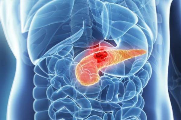 قندخون بالا خطر ابتلا به سرطان لوزالمعده را افزایش می دهد قندخون بالا خطر ابتلا به سرطان لوزالمعده را افزایش می دهد